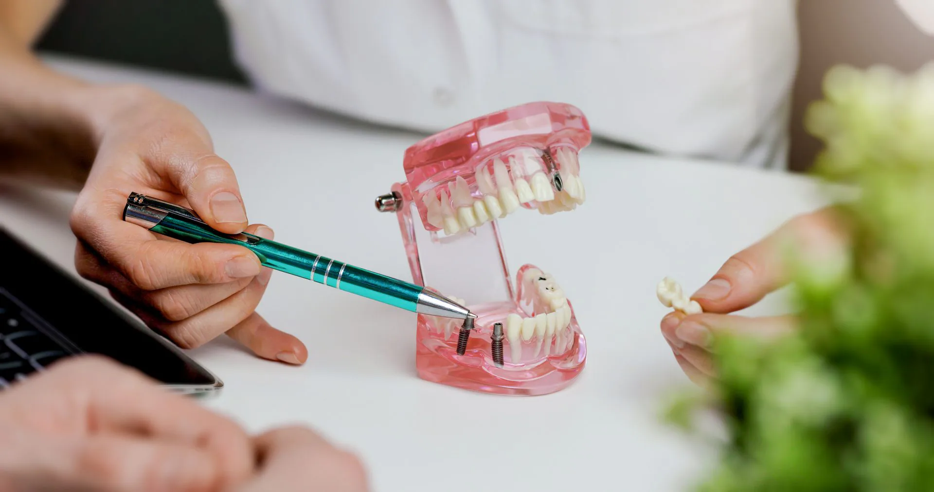 One fee dental implants in Brunswick, GA